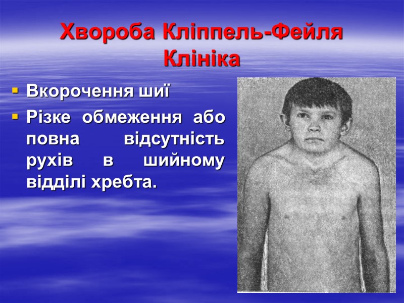 Хвороба Кліппель-Фейля  Клініка Вкорочення шиї Різке обмеження або повна відсутність рухів в шийному